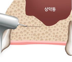 시술과정1