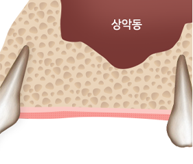 시술과정2