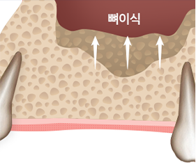 시술과정3