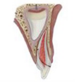 Crown-root fracture without pulp involvement