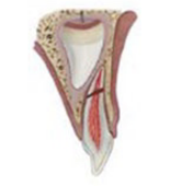 Root fracture