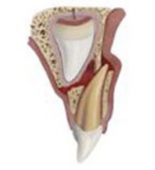 Alceolar fracture