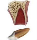 Avulsion