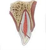 Crown-root fracture without pulp involvement