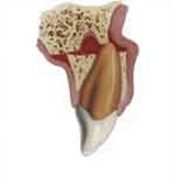 Alceolar fracture